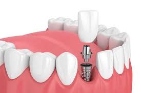 Dental Implant Surgery