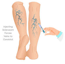 Varicose Vein Treatment